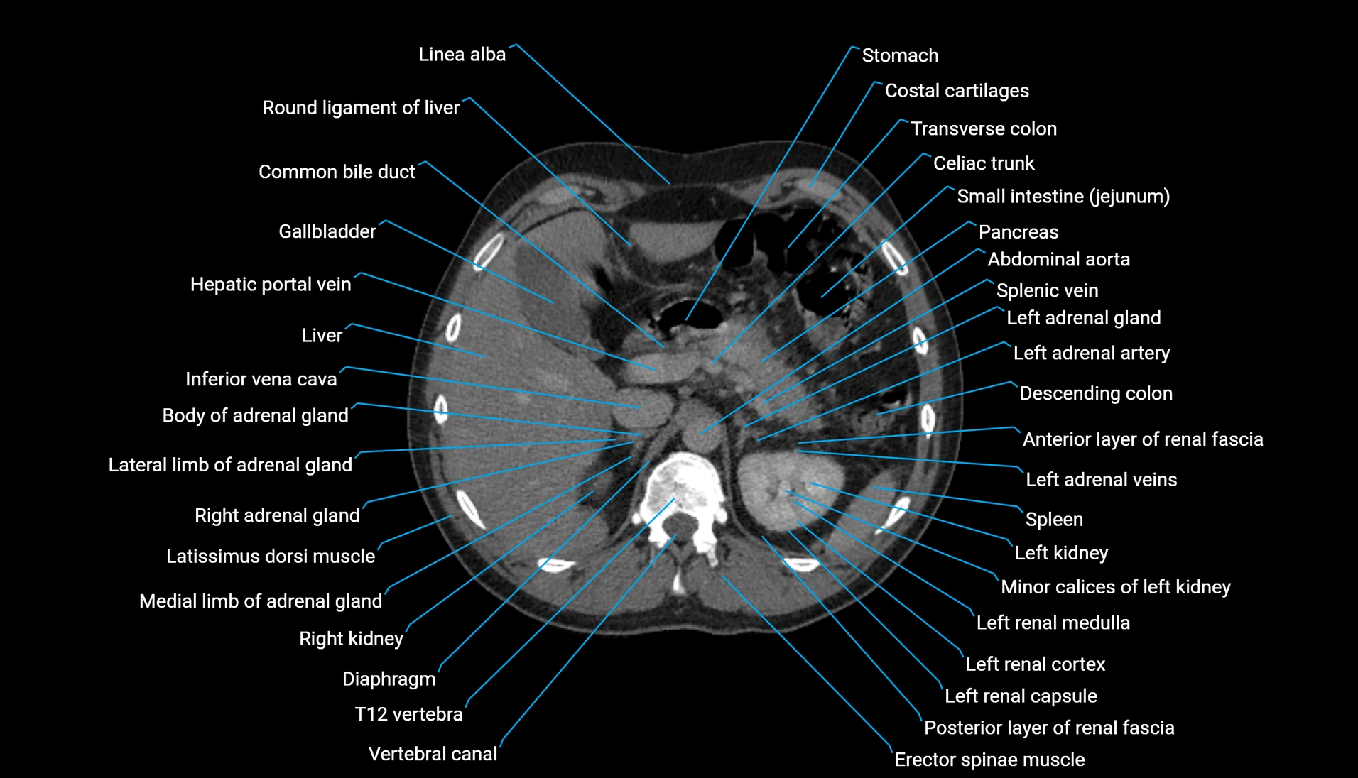 CT urogram axial cross sectional anatomy  labelled radiology image-00077.webp